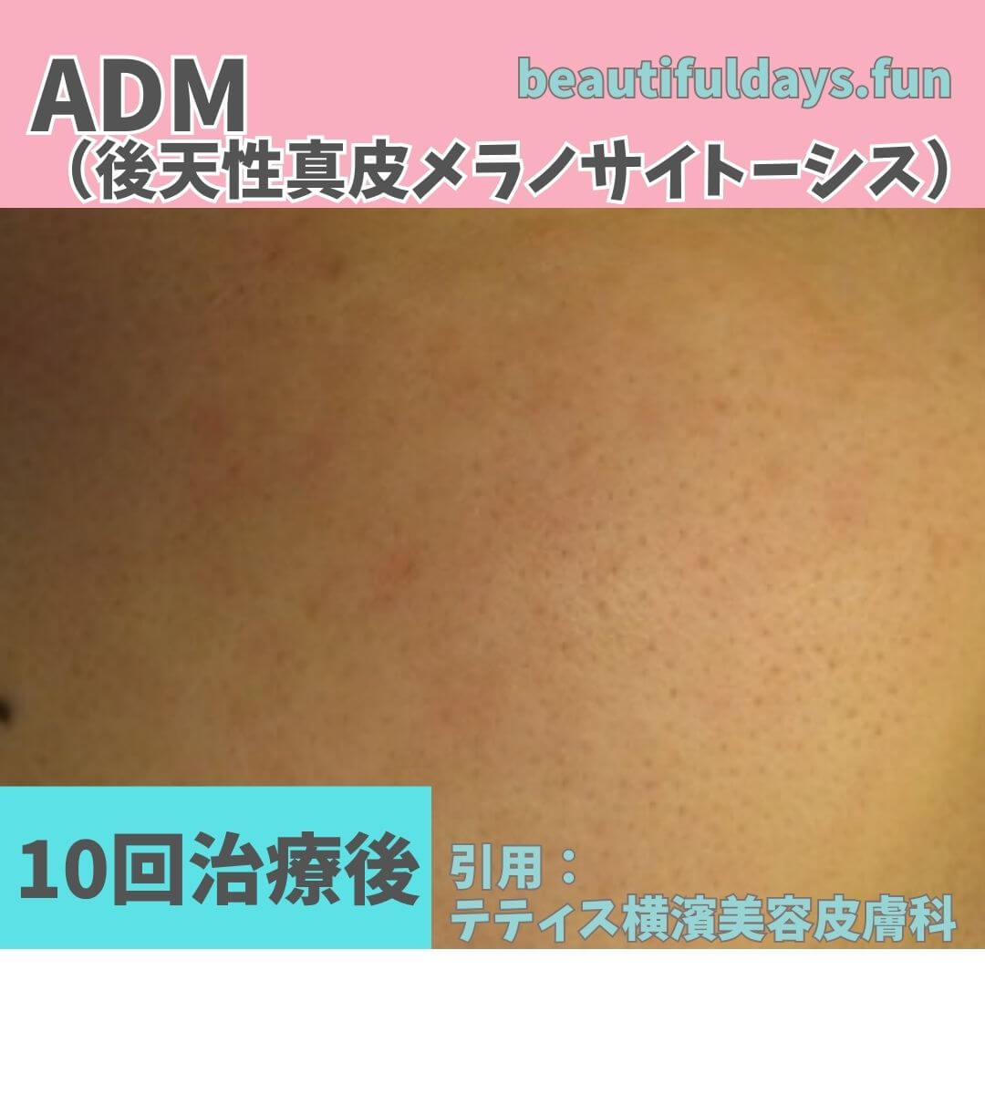 ADM-After