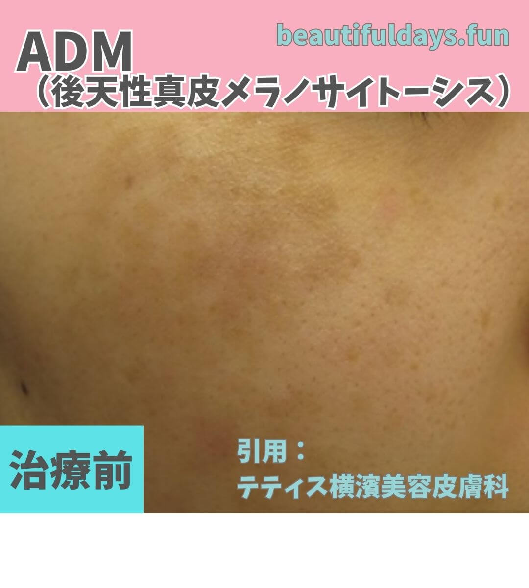 ADM-Before