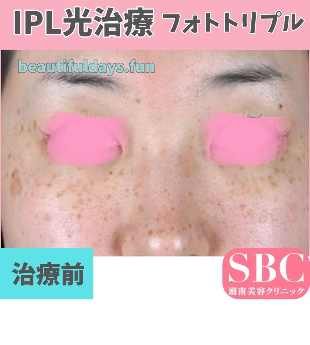 IPL3-before