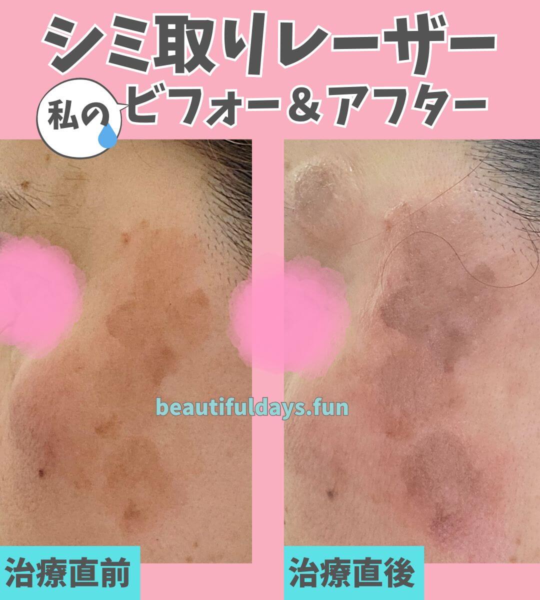 シミ取りレーザーってどんなことするの？体験ブログ／湘南美容クリニック | 私たちのビューティフルデイズ