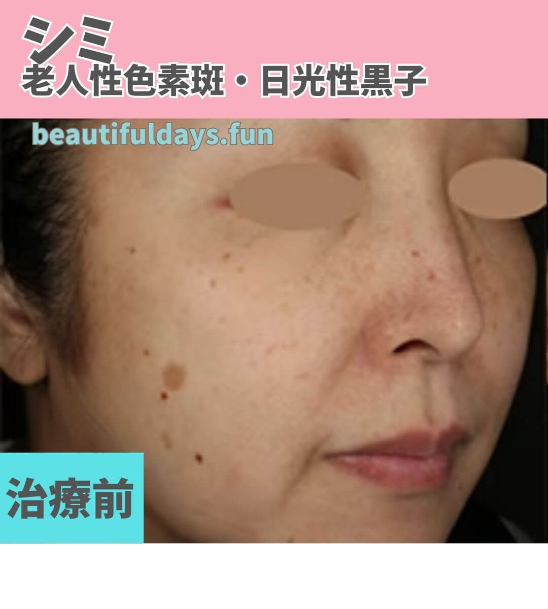 age spots-before (1)
